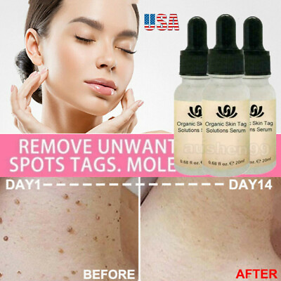 #ad 5 1 PCS Organic Tags Solutions Serum Mole amp; Skin Tag Remover Herbal Wart Removal $8.85